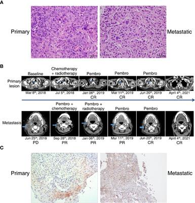 Durable Complete Response to Pembrolizumab in Esophageal Squamous Cell Carcinoma With Divergent Microsatellite Status: A Case Report